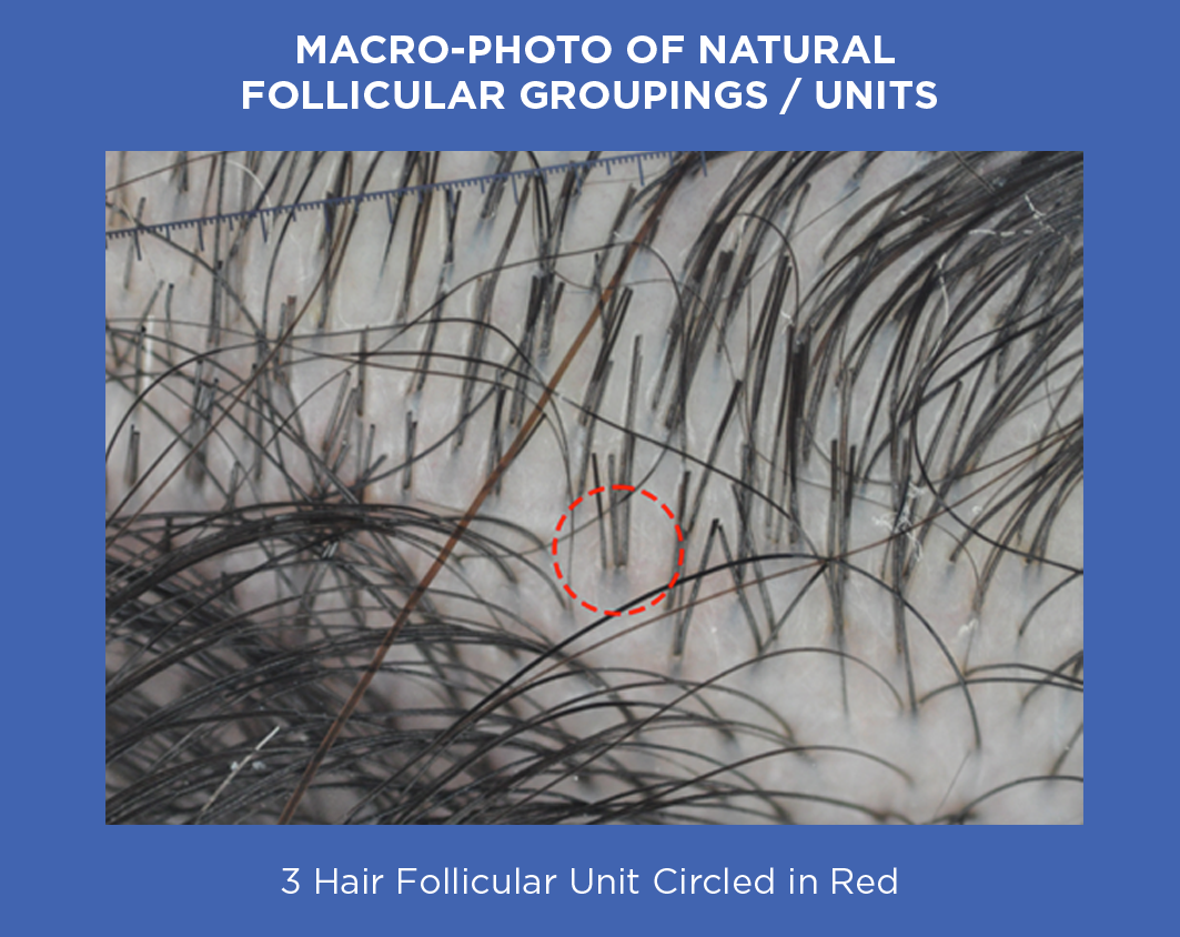 Macro-Photo of Natural Follicular Groupings / Units