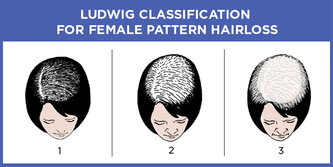 Ludwig Classification For Female Pattern Hair Loss