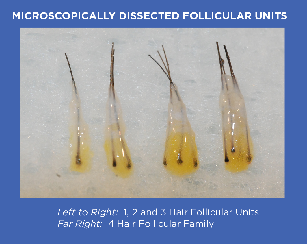 Microscopically Dissected Follicular Units