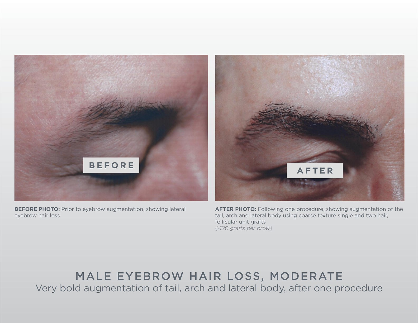 Gallery | GL Perrault MD | Hair Loss and Hair Restoration