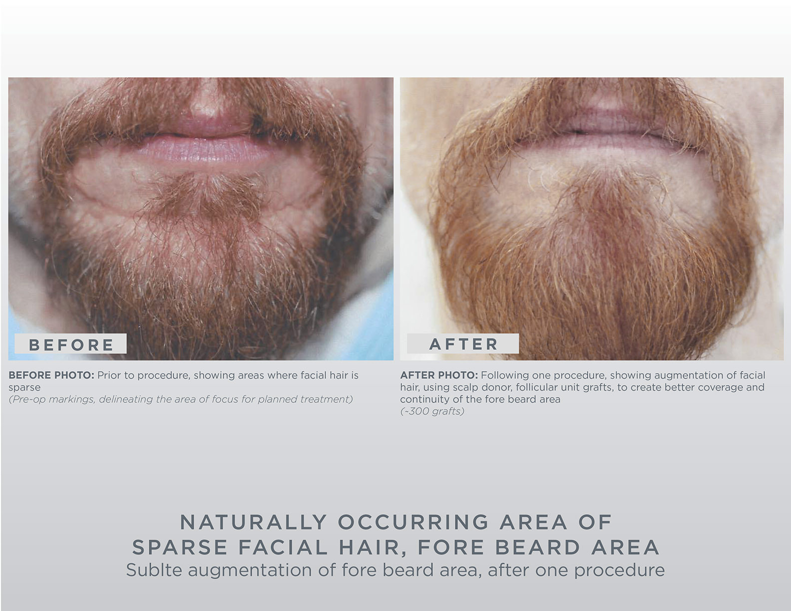 gallery-gl-perrault-md-hair-loss-and-hair-restoration