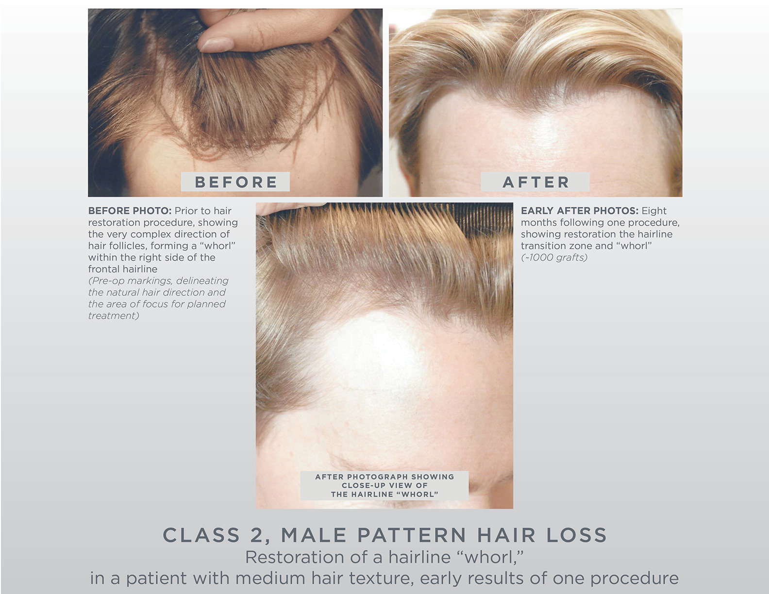 Gallery Gl Perrault Md Hair Loss And Hair Restoration