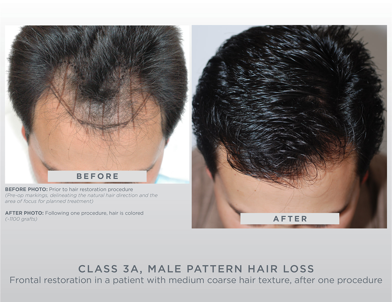 Gallery Gl Perrault Md Hair Loss And Hair Restoration