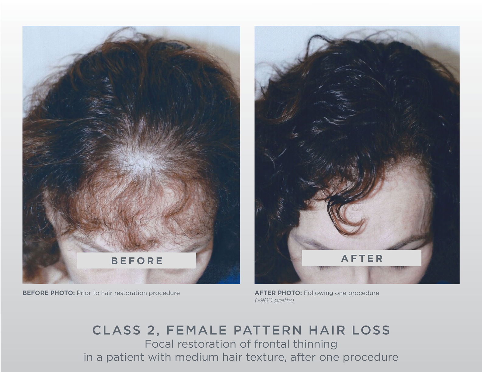 Gallery Gl Perrault Md Hair Loss And Hair Restoration