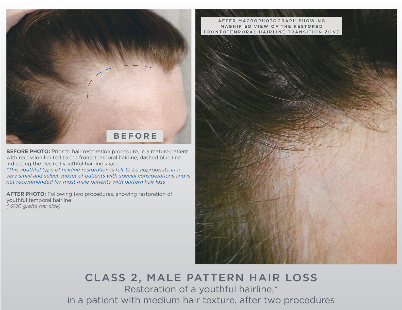 Gallery Gl Perrault Md Hair Loss And Hair Restoration