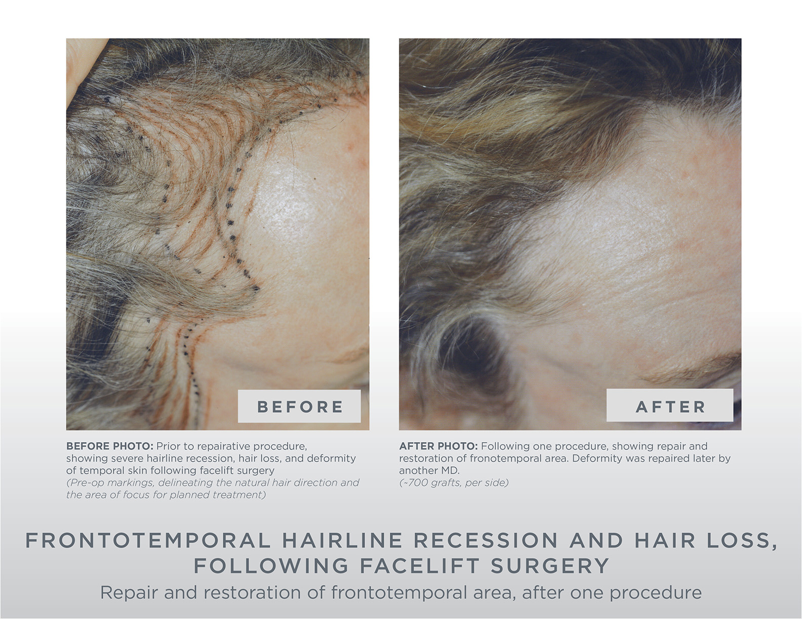 Gallery | GL Perrault MD | Hair Loss and Hair Restoration