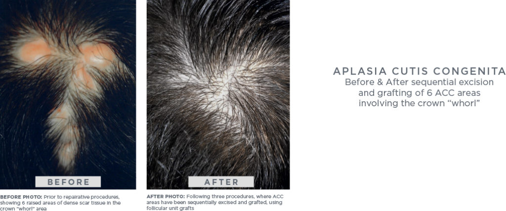 Congenital Hair Follicle Deficiency (Hypotrichosis) | GL Perrault MD | Hair  Loss and Hair Restoration